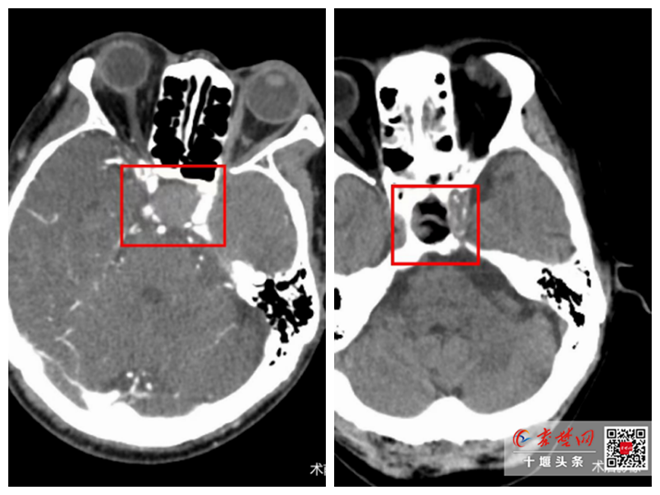 经鼻潜入脑，切瘤不伤脑 十堰人医成功实施经鼻蝶垂体瘤微创切除术
