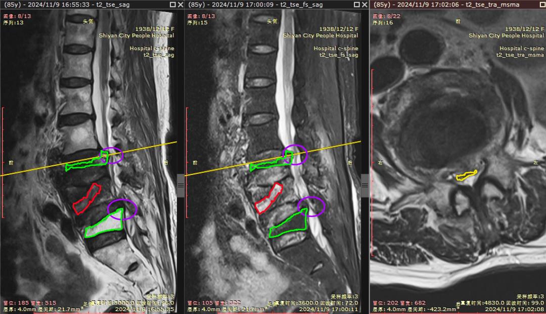 端水闪着腰，一查竟腰椎骨折！十堰人医：这类人群要警惕