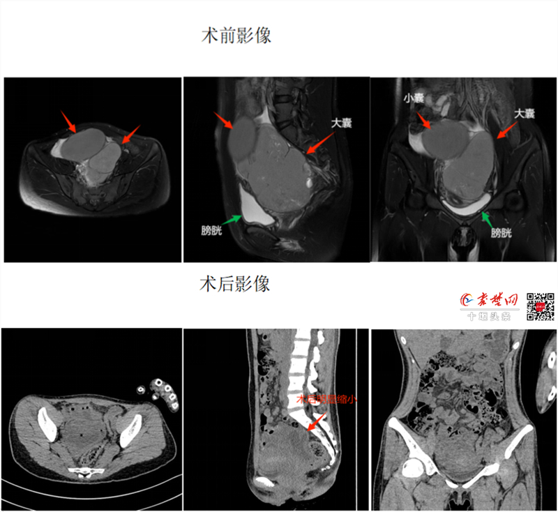 不开刀！十堰人医一根“针”解决女性常见巧克力囊肿难题
