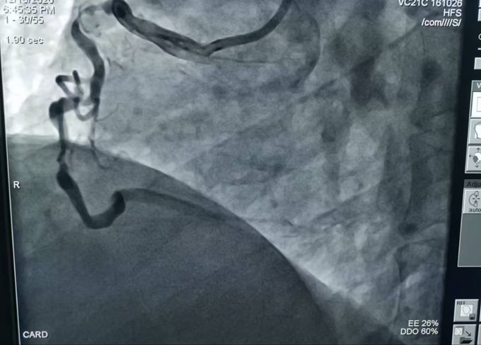 3根心脏动脉血管严重堵塞 危及生命！十堰人医2次手术为七旬大爷解除“警报”