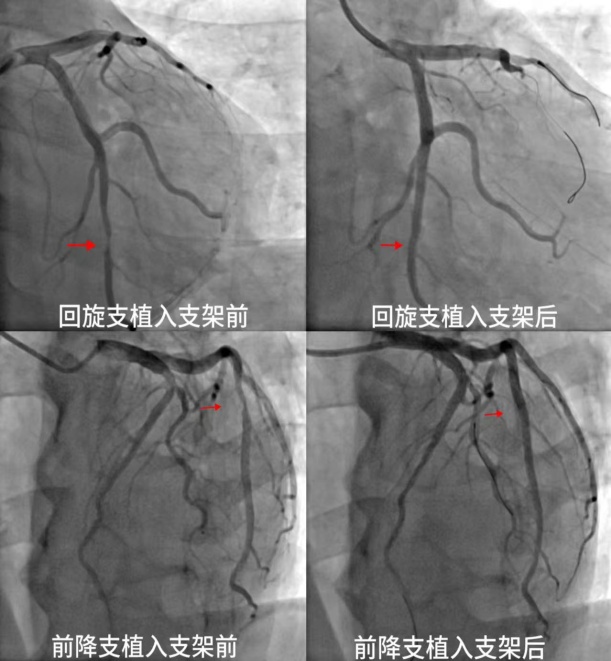 “生命通道”重获生机，十堰人医成功救治复杂冠心病危重患者