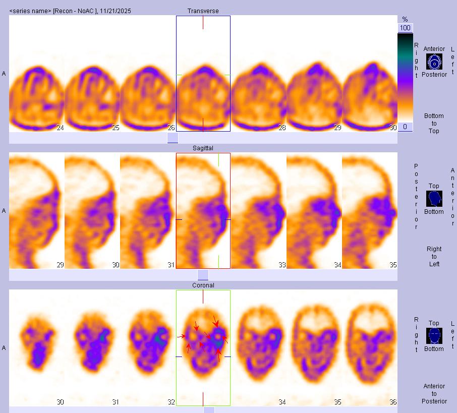 十堰人医核医学科：甲状腺相关性眼病显像检查流程及注意事项
