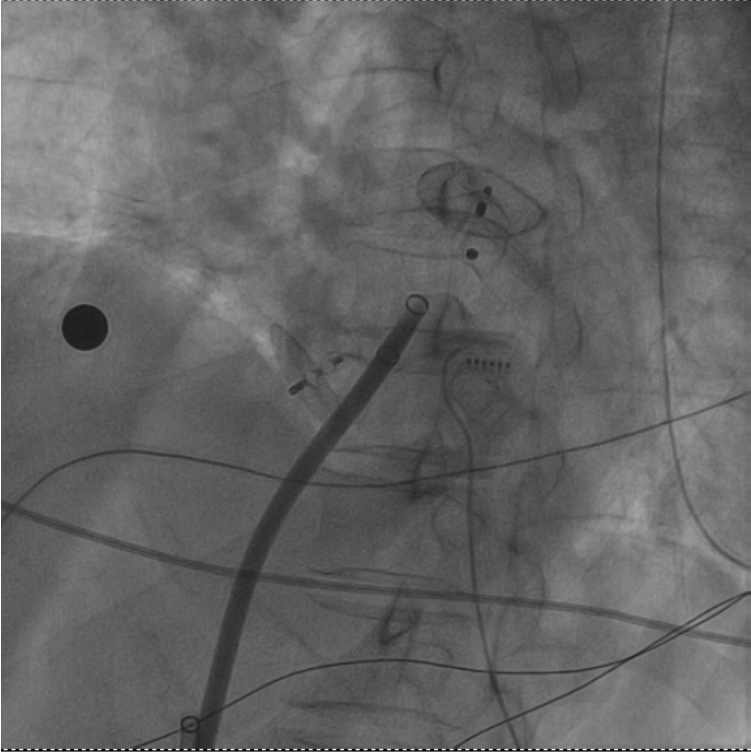 一次穿刺行两个手术！十堰人医成功消除圆孔封堵术后的房颤与血栓