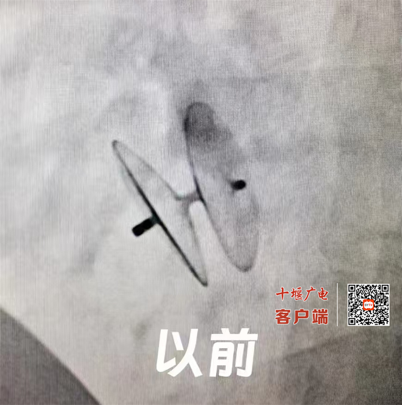 十堰人医可降解封堵器治疗卵圆孔未闭取得成功