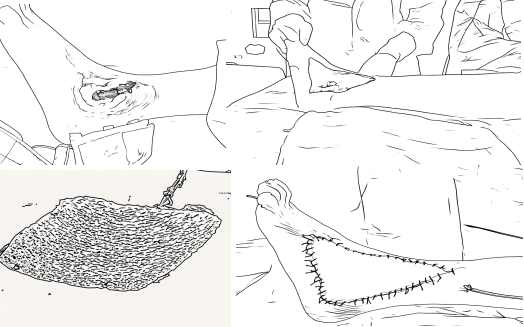 十堰市人民医院成功实施高难度皮瓣移植术 直面挑战创奇迹 治愈患者获赞誉