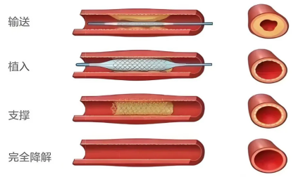 十堰首例！“无痕”支架植入术成功实施