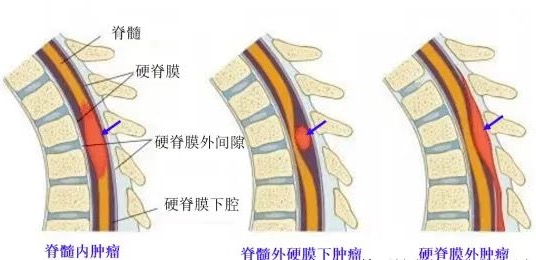 腰腿痛元凶：竟是椎管内肿瘤！十堰人医精准除瘤阻截瘫