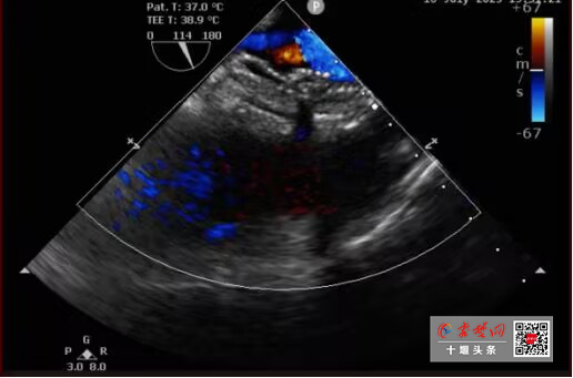 全国首例！十堰人医“双降解”封堵术巧补心脏双“洞”不留痕