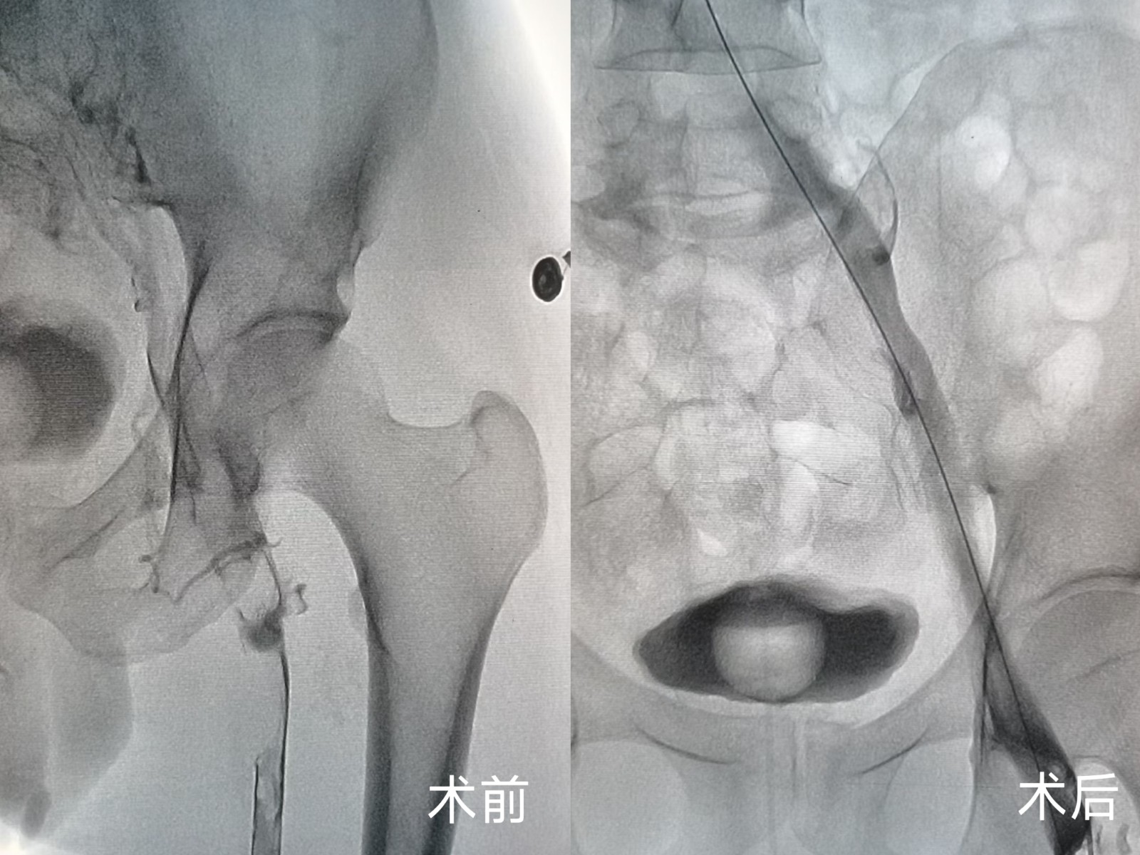 十堰人医心胸大血管外科外周静脉取栓支架系统精准取栓解沉疴